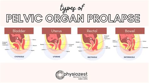 Vaginal Prolapse .